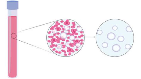 Akut myeloisk leukemi
